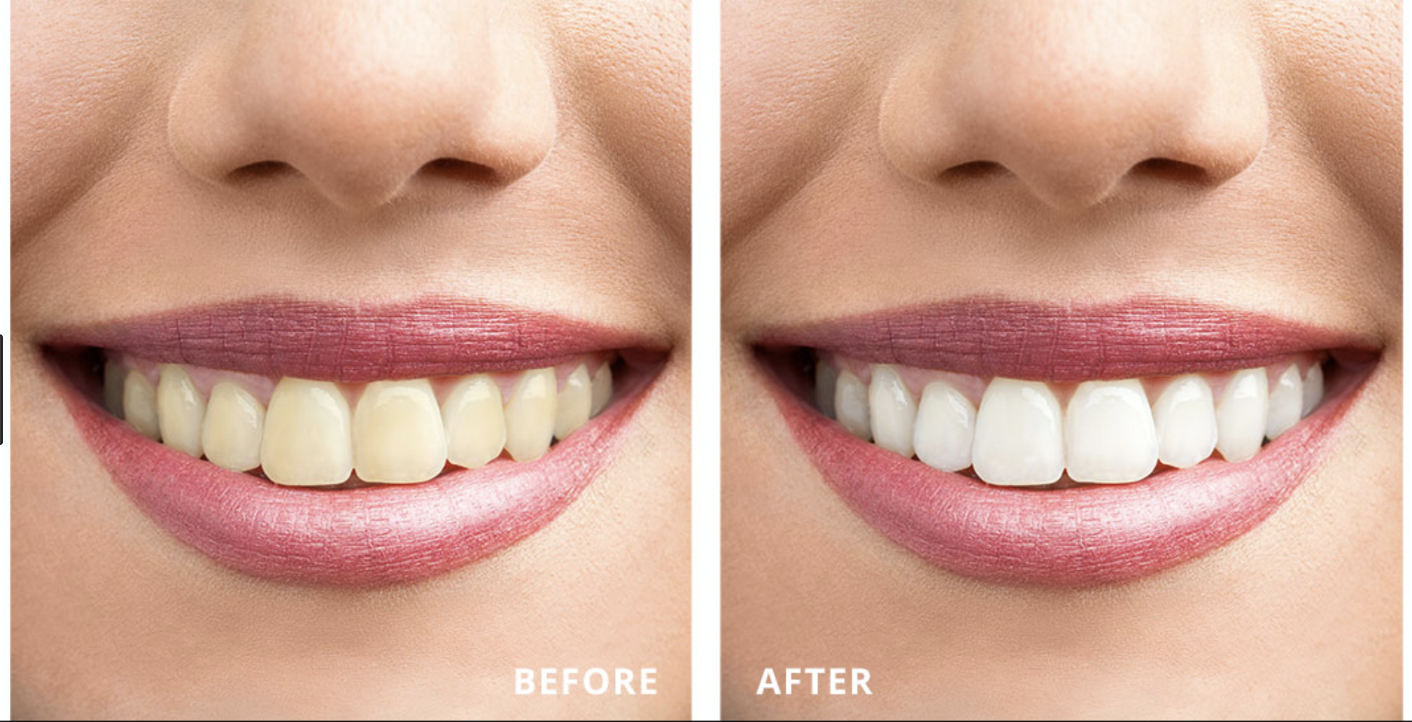 Teeth Whitening Services at Ash Tree Dental Office in Fresno, Ca