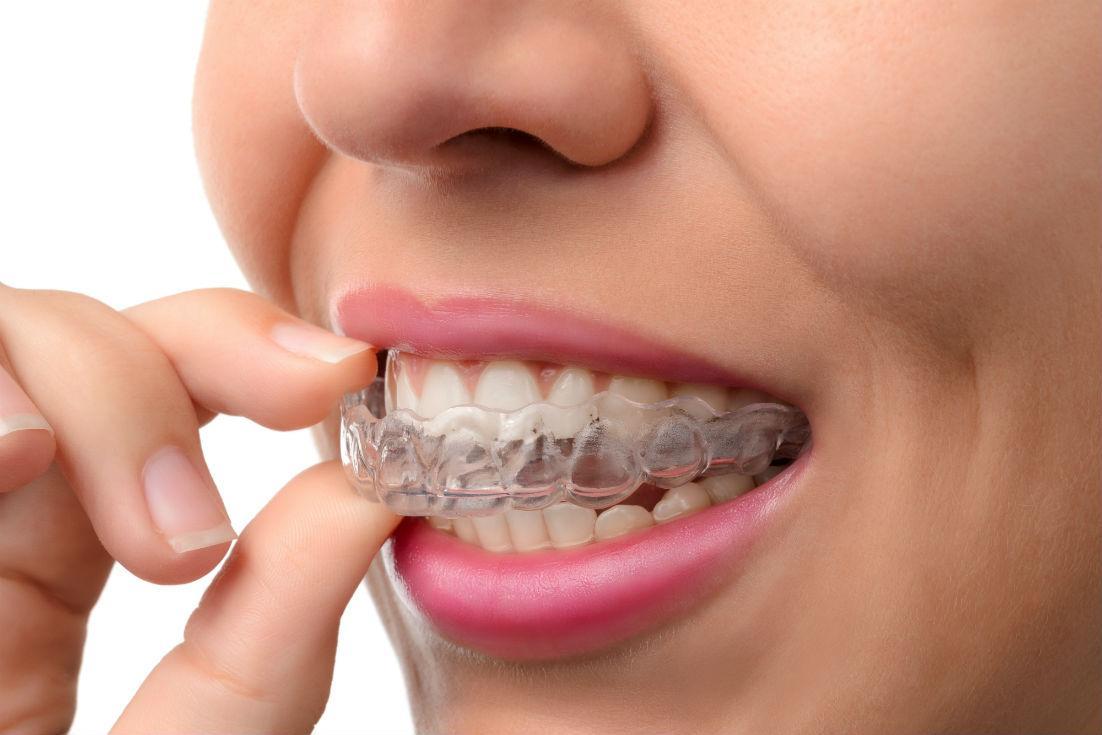 Invisalign® Clear Braces - Weber Dental Center - Spokane Valley, WA